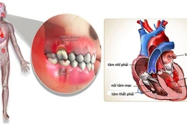 Viêm nội tâm mạc nhiễm khuẩn