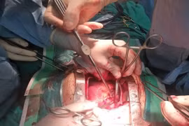 Cứu sống bệnh nhân vỡ tim