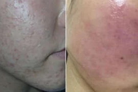 Biến thành bà lão vì thuốc dị ứng