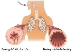 Ho lâu ngày không khỏi: hãy dùng Bảo Phế Vương