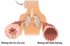 Ho lâu ngày không khỏi: hãy dùng Bảo Phế Vương