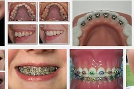 Chỉnh răng dễ gây biến dạng mặt?