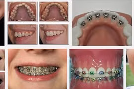 Chỉnh răng dễ gây biến dạng mặt?