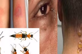 Độc tố kiến ba khoang độc hơn nọc rắn, cẩn thận xử lý kẻo rước hoạ vào thân