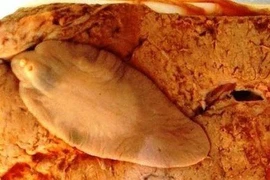 Thích ăn gỏi cá coi chừng sán lá gan