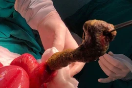 Bé gái tắc ruột vì hội chứng "ăn tóc"