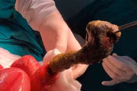 Bé gái tắc ruột vì hội chứng "ăn tóc"