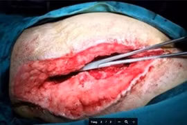 Trám vạt cơ vào ổ cối trị rò vết mổ thay khớp 