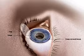 Lưu ý khi phẫu thuật cận thị