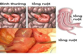 Lồng ruột lại tưởng kiết lỵ