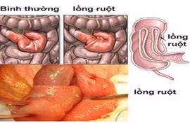 Lồng ruột lại tưởng kiết lỵ