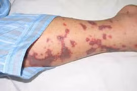 Vì sao viêm não mô cầu lại hay tấn công trẻ bụ bẫm, người khỏe mạnh?