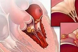 Điều trị bệnh thấp tim do khớp