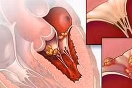 Điều trị bệnh thấp tim do khớp