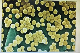 Người bị viêm họng, viêm xoang chế biến thực phẩm có thể gây ngộ độc