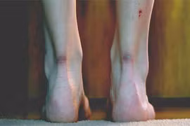 “Cấy tóc” vào vết thương để xóa vết sẹo vĩnh viễn