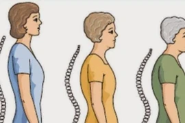 Tại sao phụ nữ sau mãn kinh lại thấp đi? 