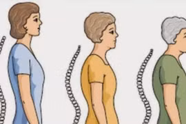 Tại sao phụ nữ sau mãn kinh lại thấp đi? 