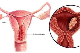 Ra máu ngoài kỳ kinh, cảnh giác ung thư nội mạc tử cung