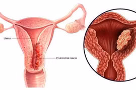 Ra máu ngoài kỳ kinh, cảnh giác ung thư nội mạc tử cung