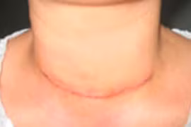 Đường mổ đẹp 