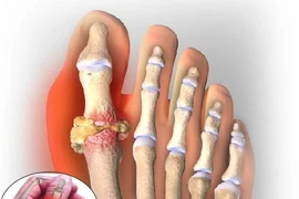 Chữa đau gút khi thời tiết chuyển mùa