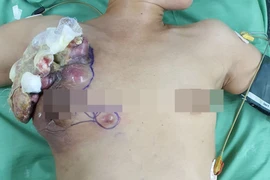 Khối u vú lở loét, bốc mùi vì không chịu đi khám