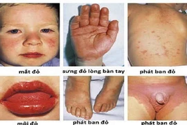 Kawasaki: Căn bệnh nguy hiểm với trẻ em