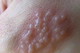 Nổi bọng nước đắp lá chảy mủ vàng