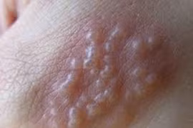 Nổi bọng nước đắp lá chảy mủ vàng