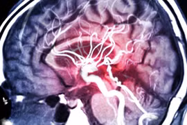 Ảnh chụp cộng hưởng từ MRA mạch máu trong não. Ảnh ScitechDaily
