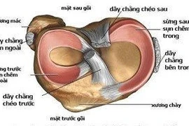 Rách sụn chêm khớp gối 