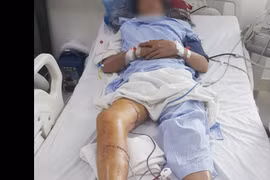 Bệnh viện Chợ Rẫy TPHCM: Hỗ trợ bệnh nhân tuyến dưới giữ lại chân bị cắt do máy cưa 