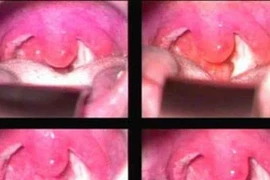 3 bệnh về họng hay gặp trong mùa lạnh