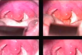 3 bệnh về họng hay gặp trong mùa lạnh