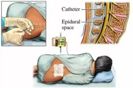 Tiêm Steroid ngoài màng cứng điều trị đau cổ và lưng