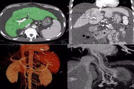 Can thiệp TIPS cứu bệnh nhân xơ gan cổ trướng