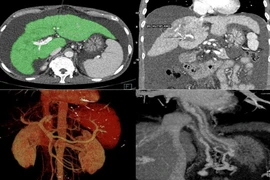 Can thiệp TIPS cứu bệnh nhân xơ gan cổ trướng