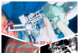 Việt Nam thành công thay bán phần khớp gối khoang ngoài