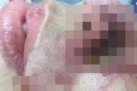 Mũi mưng mủ, có dấu hiệu hoại tử sau khi tiêm filler