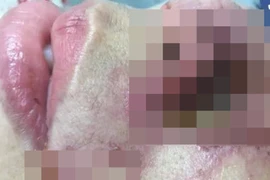 Mũi mưng mủ, có dấu hiệu hoại tử sau khi tiêm filler