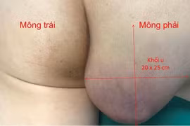 Chủ quan khiến u bã đậu hoại tử