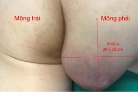 Chủ quan khiến u bã đậu hoại tử