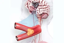 Đột quỵ thiếu máu não cục bộ - Nguyên nhân, triệu chứng và cách điều trị