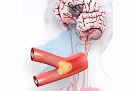 Đột quỵ thiếu máu não cục bộ - Nguyên nhân, triệu chứng và cách điều trị