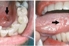 Dấu hiệu nhận biết ung thư khoang miệng