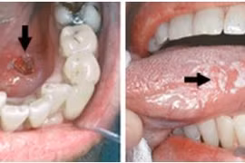 Dấu hiệu nhận biết ung thư khoang miệng