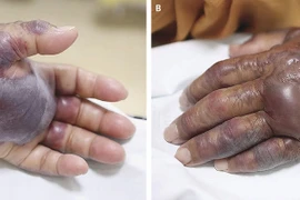 Cảnh giác với loại vi khuẩn tương tự Whitmore