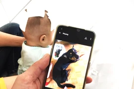 Bị kéo đuôi, chó nhà cắn xuyên sọ em bé 6 tháng tuổi