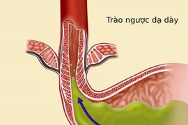 Thủ phạm gây trào ngược dạ dày thực quản